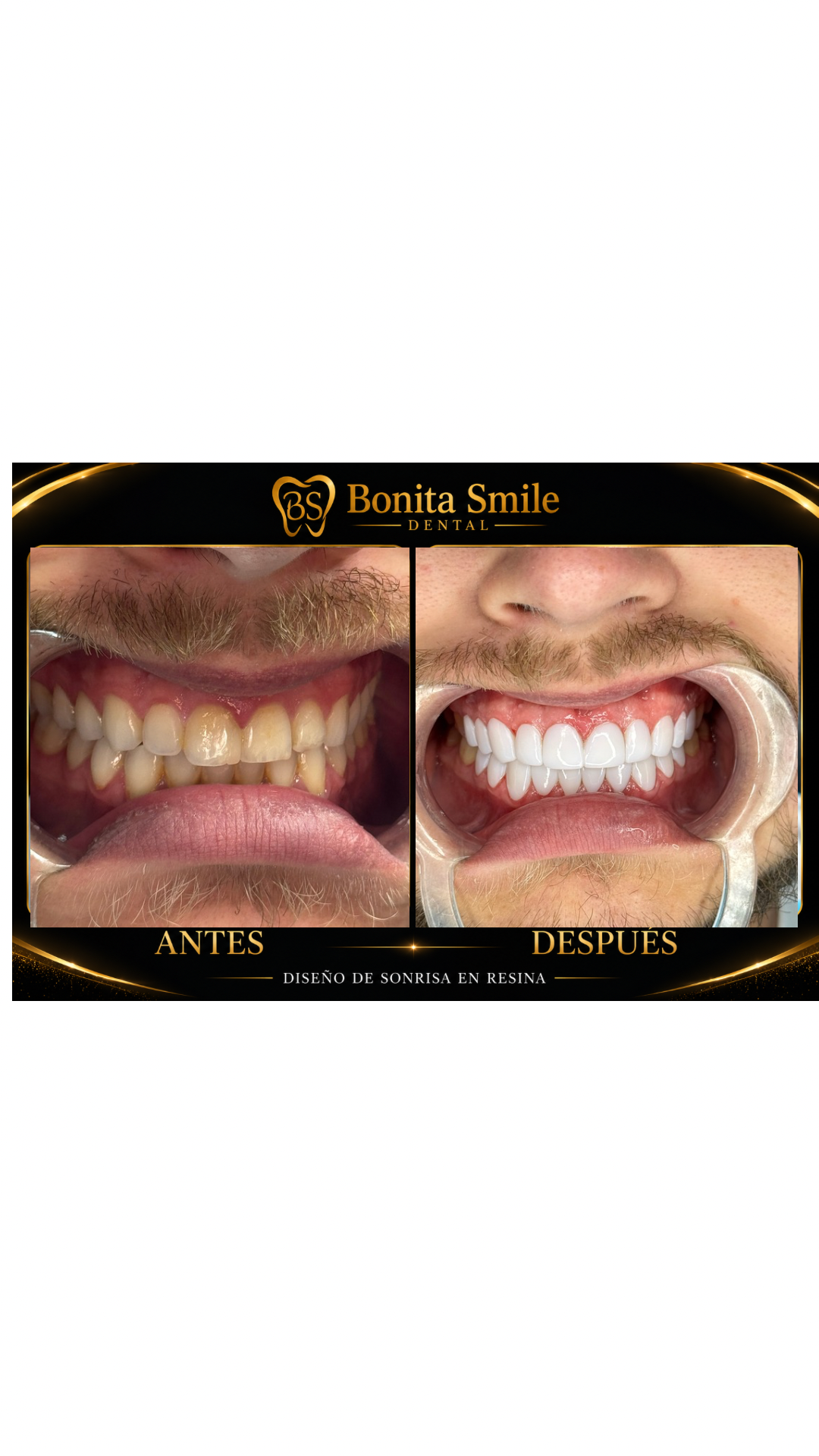 Diseño de sonrisa en resina — Antes y después