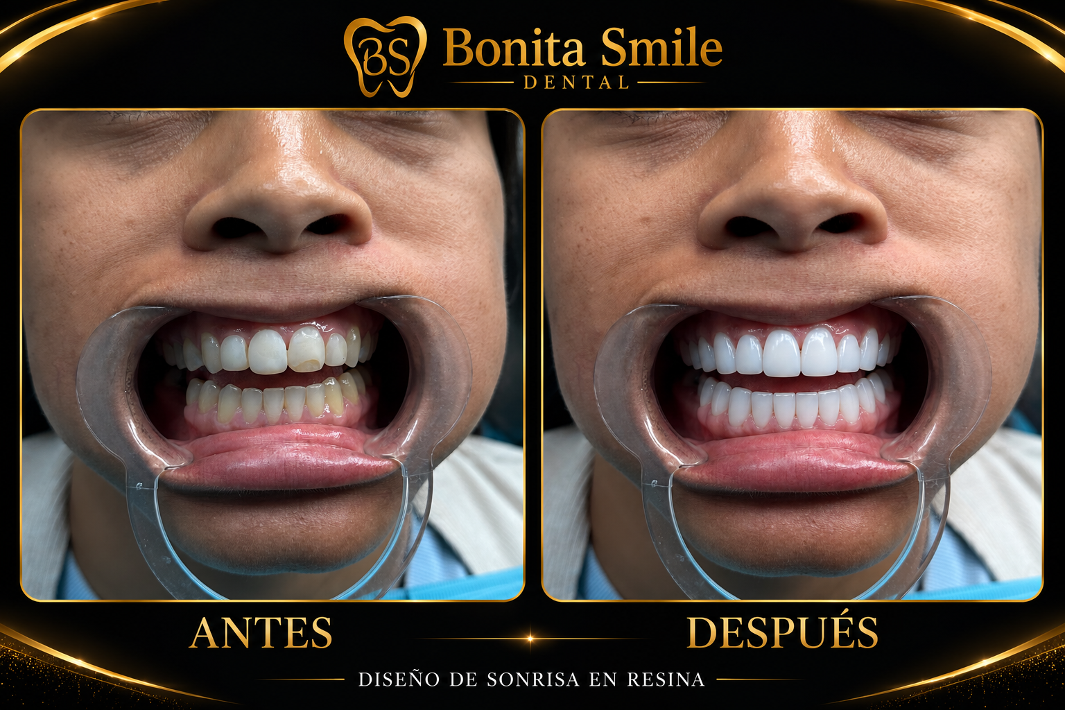 Diseño de sonrisa en resina — Antes y después