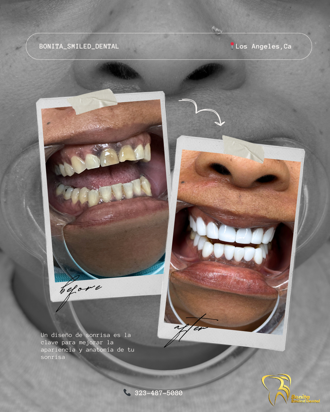 Diseño de sonrisa integral — Antes y después
