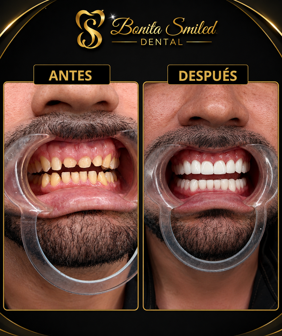 Rehabilitación estética completa — Antes y después