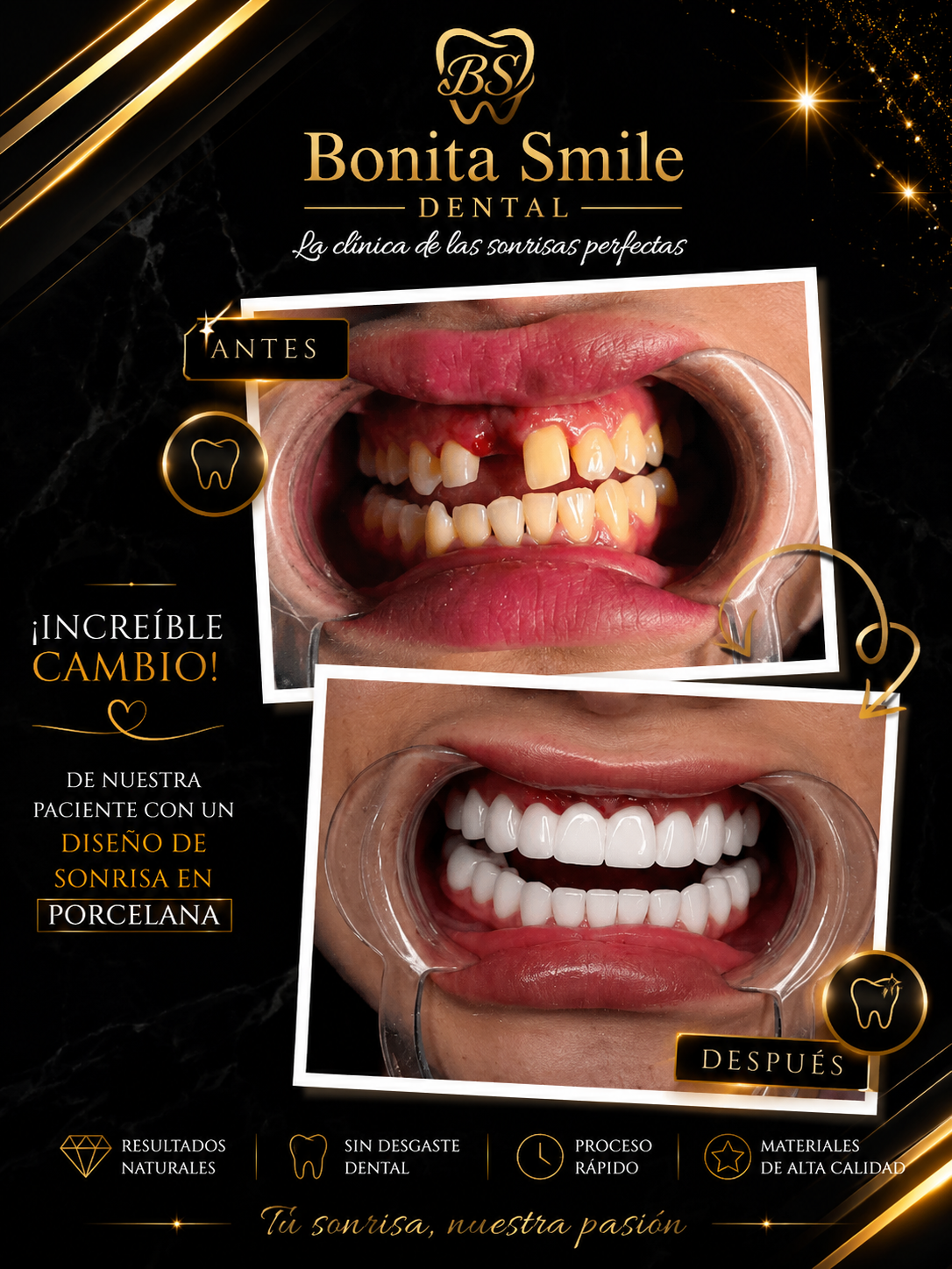 Diseño de sonrisa en porcelana — Antes y después